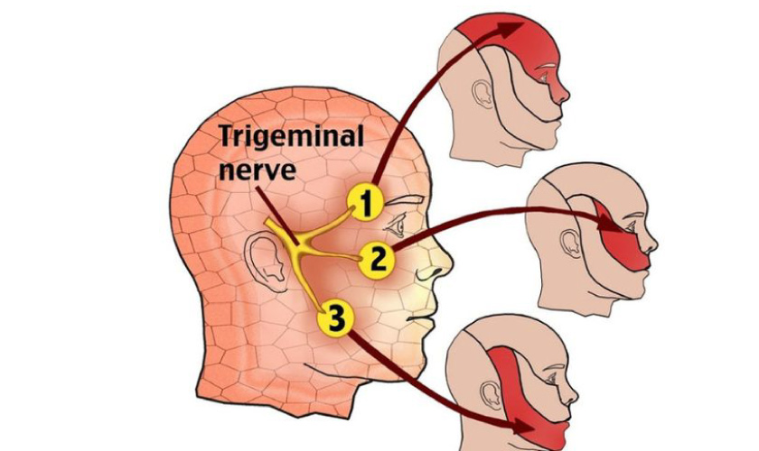 Đau dây thần kinh số 5 dễ nhầm lẫn với bệnh đau răng Đau dây thần kinh số 5 dễ nhầm lẫn với bệnh đau răng