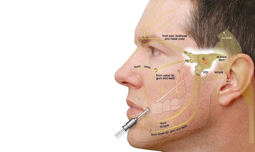 Tiêm botox trong điều trị đau dây thần kinh số 5 vô căn Tiêm botox trong điều trị đau dây thần kinh số 5 vô căn