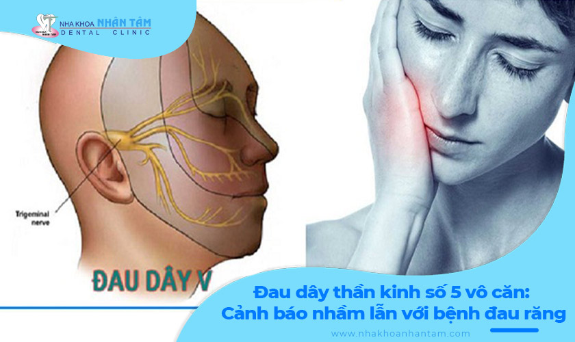 Hình: Đau dây thần kinh số 5: Nhầm lẫn phổ biến với bệnh đau răng