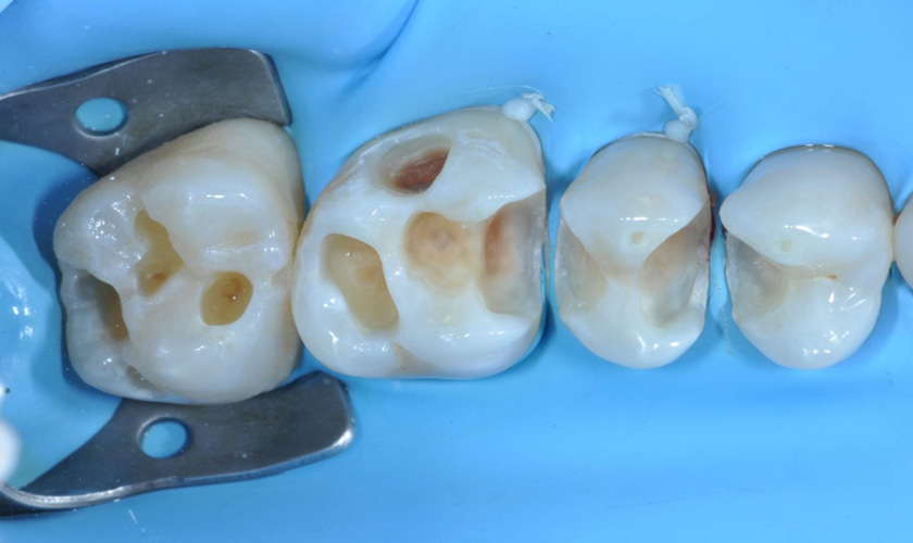 Sâu răng gây nhiễm trùng và hành sốt