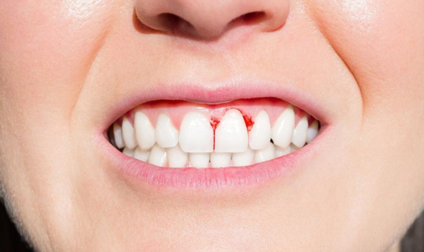 Viêm nướu cũng là nguyên nhân gây đau răng cửa