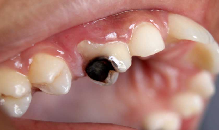Sâu răng hàm trên gây đau răng