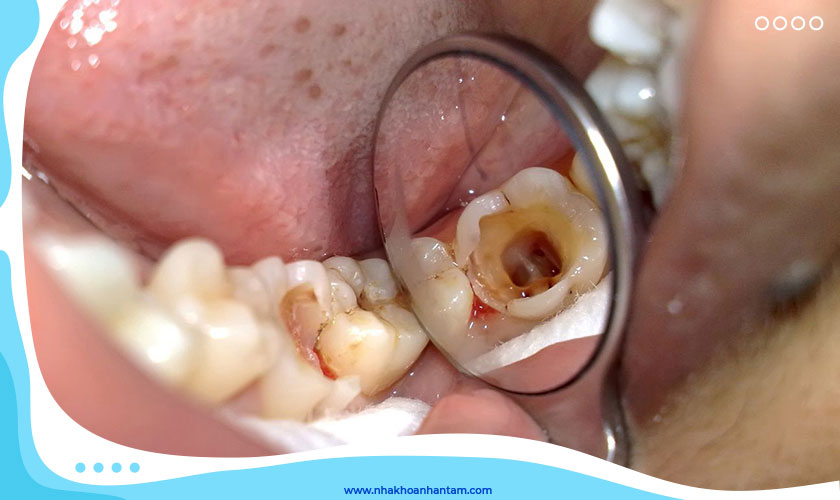 Sâu răng không điều trị kịp thời dẫn đến sâu răng vào tủy gây viêm tủy răng