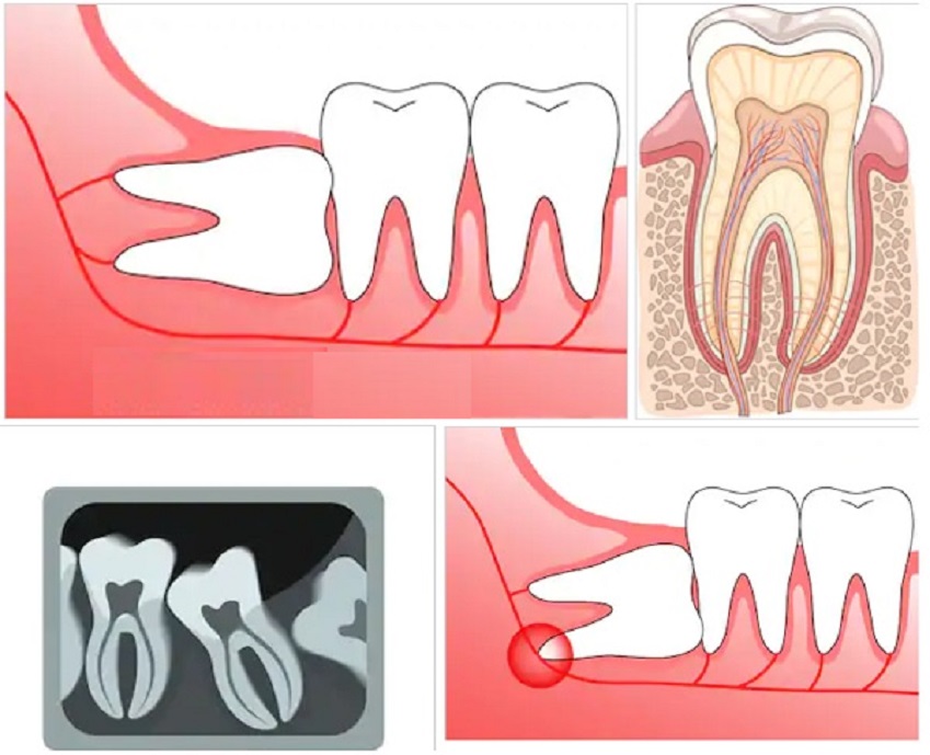 Người trưởng thành bị đau răng rất có thể do đau răng khôn