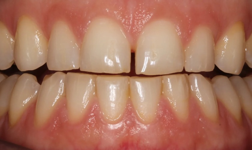 Tình trạng mòn men răng diễn ra khá phổ biến