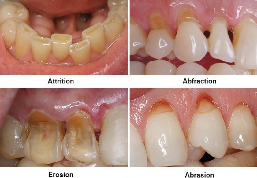 Các dấu hiệu mòn men răng