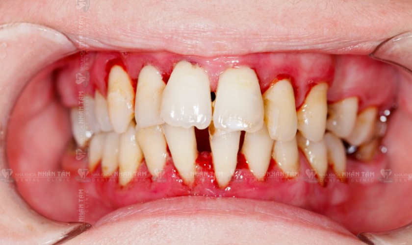 Viêm nha chu gây đau răng, sưng nướu, chảy máu nướu, tụt nướu…