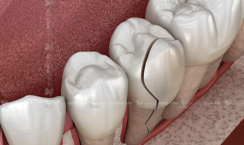Răng bị nứt vỡ do chấn thương