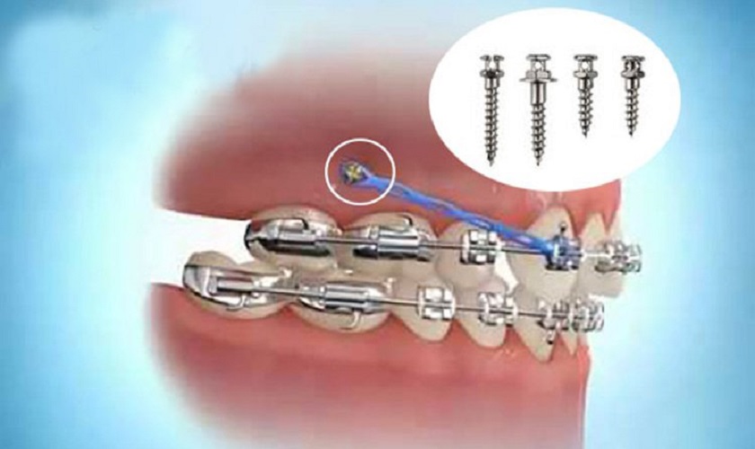 Cảm giác đau có thể xảy ra khi bắt vít niềng răng