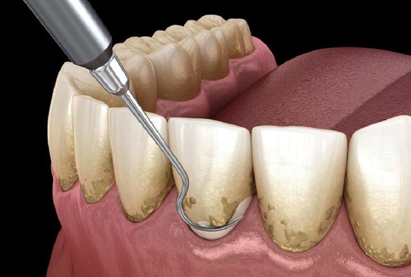 Cạo vôi răng định kỳ là cần thiết để duy trì sức khỏe răng miệng