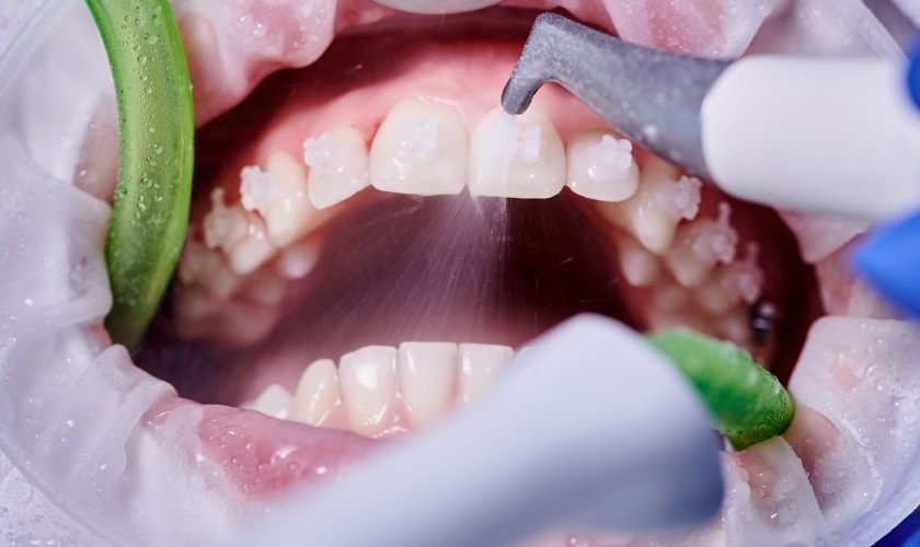 Cạo vôi răng siêu âm nhẹ nhàng, an toàn, nhanh chóng, hiệu quả