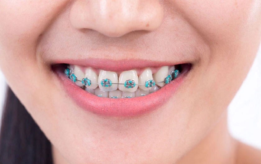 Niềng răng mắc cài kim loại