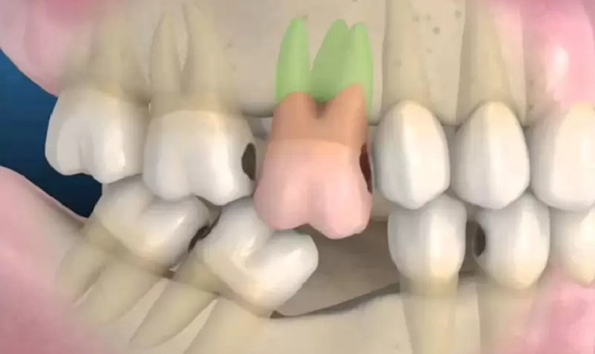 Mất răng cấm có thể gây xô lệch toàn bộ hàm răng