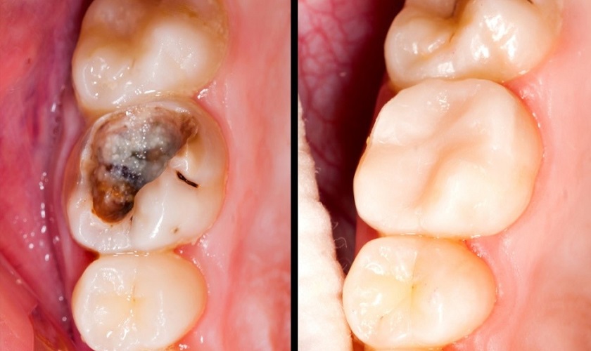 Trám răng thẩm mỹ là phương án điều trị hữu hiệu trong trường hợp sâu răng cấm mức độ nhẹ