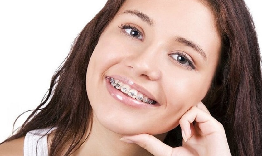 Đừng bỏ qua lưu ý niềng răng này để có hàm răng đẹp như ý muốn