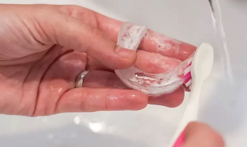 Vệ sinh sạch sẽ dụng cụ chỉnh nha tại nhà sau mỗi lần sử dụng