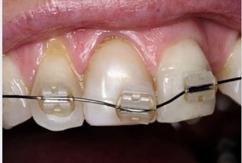 Niềng răng sai kỹ thuật gây ra cảm giác ê buốt