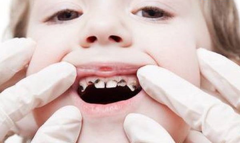 Em bé sâu răng nên điều trị thế nào? Cách phòng ngừa ra sao?
