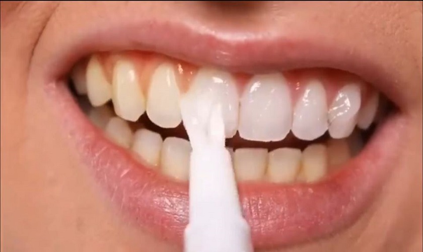 Tại sao nên sử dụng gel tẩy trắng răng thay vì phương pháp khác?