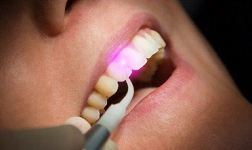 Trám răng công nghệ cao tại Nha khoa Nhân Tâm