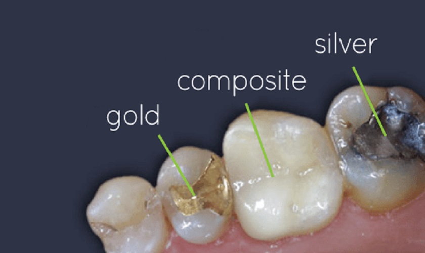 Một số loại vật liệu sử dụng trong kỹ thuật trám răng tại nha khoa Một số loại vật liệu sử dụng trong kỹ thuật trám răng tại nha khoa