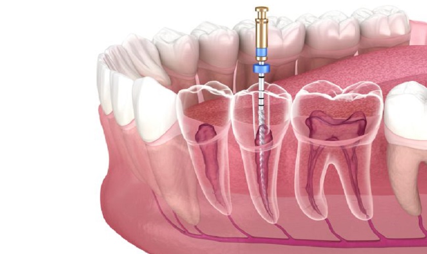 Điều trị tủy răng trước khi trám cho răng sâu Điều trị tủy răng trước khi trám cho răng sâu