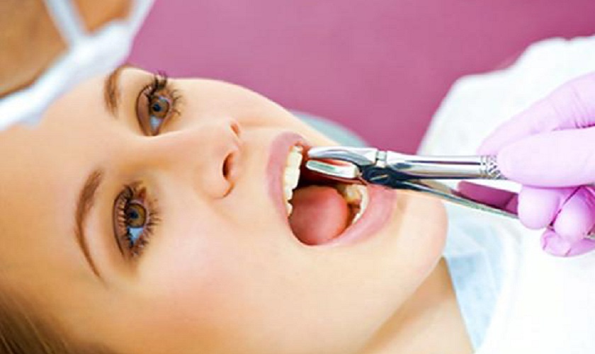 Niềng răng nhổ răng nào?