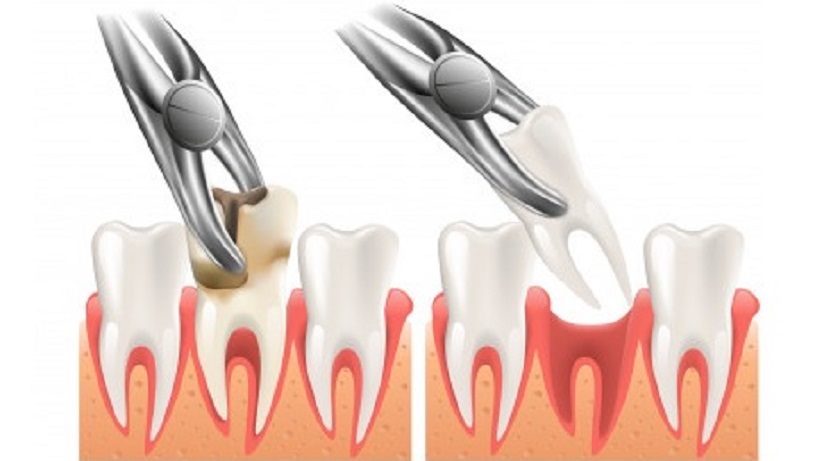 Nhổ răng có gây đau nhức lâu không?