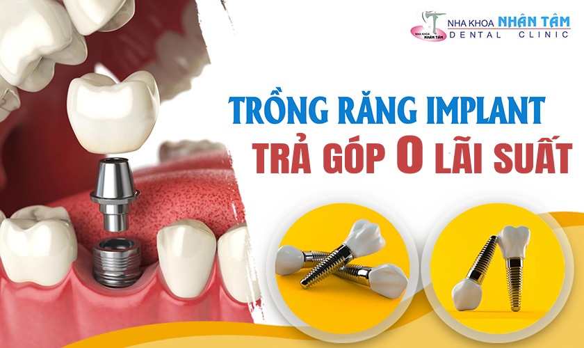 Dịch vụ trồng răng Implant trả góp