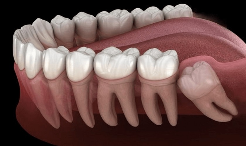 Răng khôn không đảm nhận chức năng thẩm mỹ hay ăn nhai và có nguy cơ mọc lệch cao