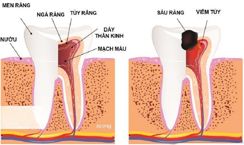 Hình ảnh viêm tủy răng và nguyên nhân, triệu chứng, cách khắc phục