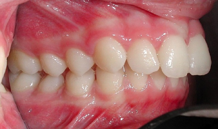 Tình trạng hô do hàm