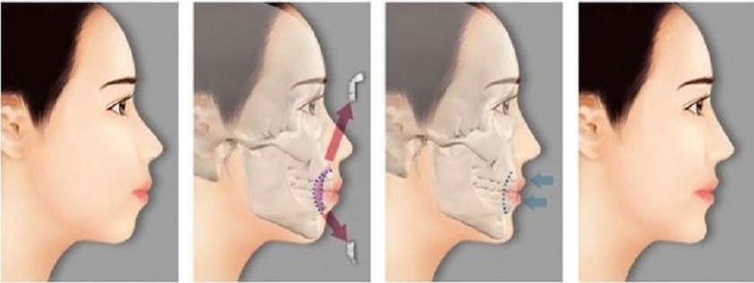 Cần phẫu thuật hàm với các trường hợp hô do hàm