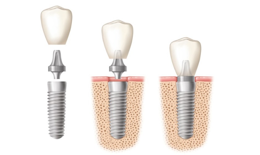 Cấy ghép răng implant tại Nha khoa Nhân Tâm