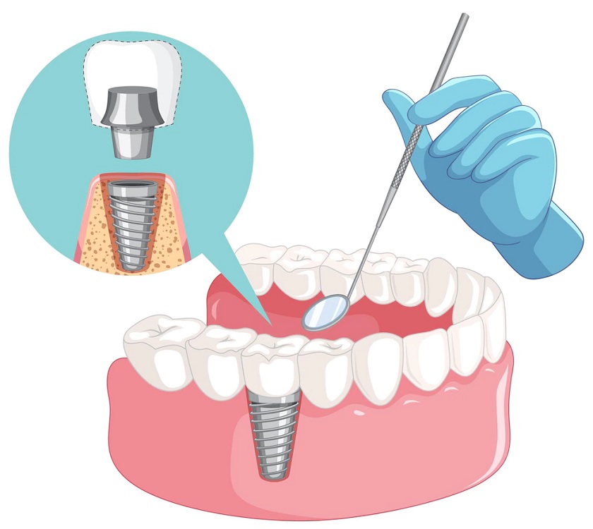 Cấy ghép Implant là kỹ thuật cao, đòi hỏi sự chính xác tuyệt đối ở các khâu trong quy trình thực hiện Cấy ghép Implant là kỹ thuật cao, đòi hỏi sự chính xác tuyệt đối ở các khâu trong quy trình thực hiện