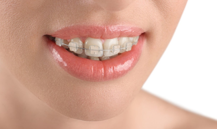 Niềng răng là giải pháp hữu hiệu giúp khắc phục tình trạng răng giữa hô