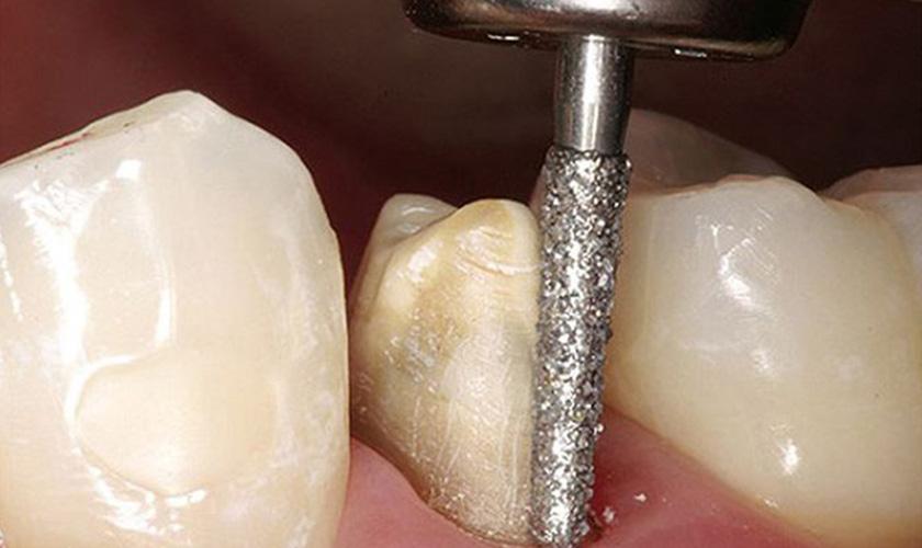 Bọc răng sứ cần phải mài răng nên bạn cần thăm khám kỹ lưỡng để bác sĩ tư vấn cụ thể