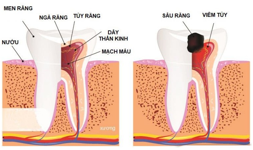Răng bị viêm tủy nhưng không điều trị triệt để sẽ gây đau nhức sau khi bọc sứ Răng bị viêm tủy nhưng không điều trị triệt để sẽ gây đau nhức sau khi bọc sứ