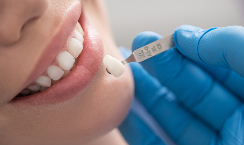 Bọc sứ thẩm mỹ mang đến hàm răng đều, đẹp