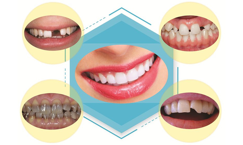 Những trường hợp nên bọc răng sứ