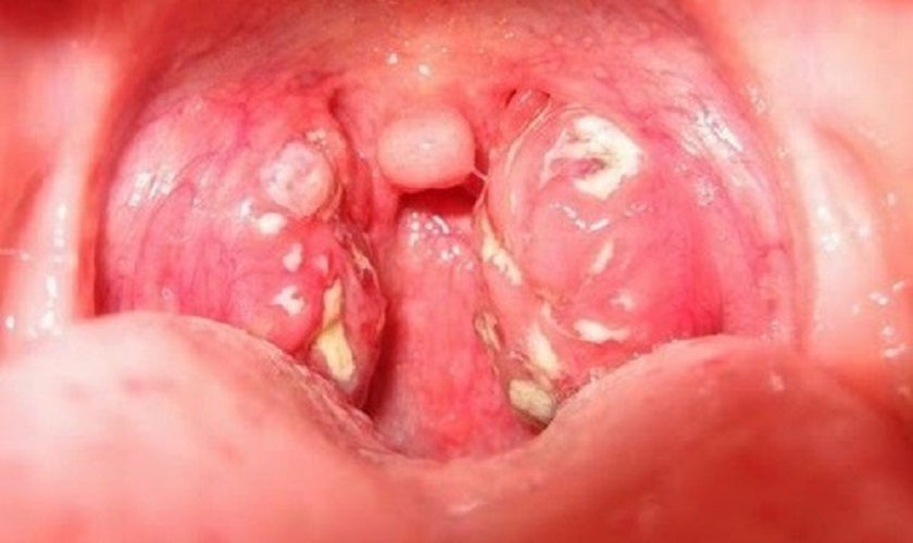 Viêm amidan là nguyên nhân gây hôi miệng từ cổ họng