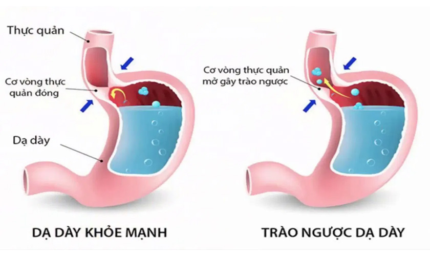 Bệnh trào ngược dạ dày - thực quản gây hôi miệng
