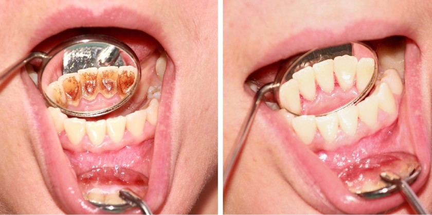 Cạo vôi răng tại nha khoa