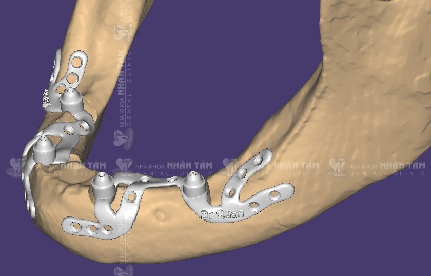 Implant cá nhân hóa không cần thực hiện ghép xương Implant cá nhân hóa không cần thực hiện ghép xương