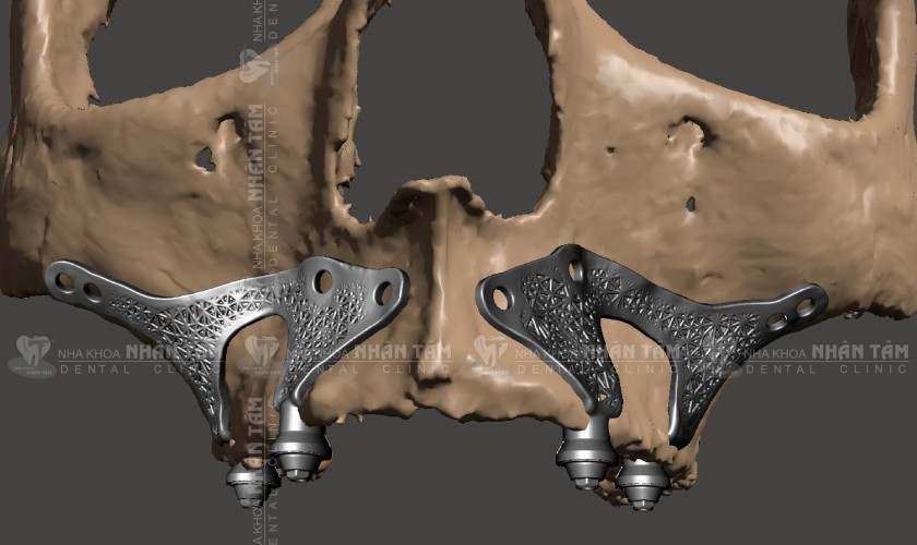 Implant cá nhân hóa giảm thiểu sự can thiệp vào cấu trúc xương hàm Implant cá nhân hóa giảm thiểu sự can thiệp vào cấu trúc xương hàm