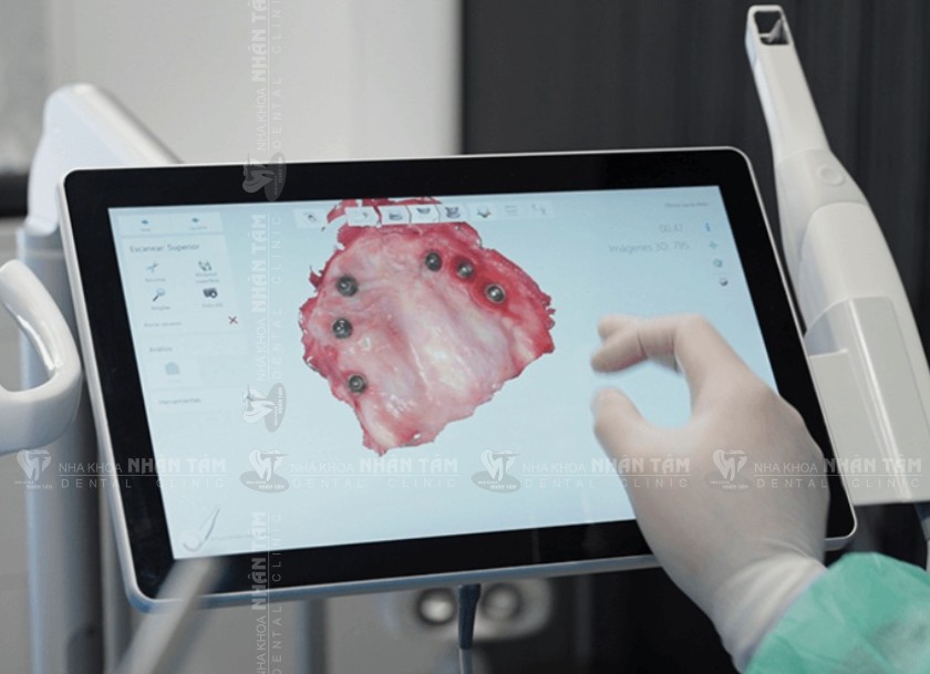 Công nghệ lấy dấu răng kỹ thuật số Công nghệ lấy dấu răng kỹ thuật số