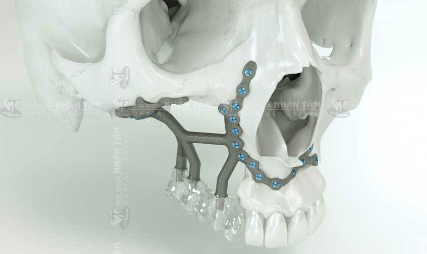 Implant cá nhân hóa tại Việt Nam vẫn gặp một số thách thức lớn Implant cá nhân hóa tại Việt Nam vẫn gặp một số thách thức lớn