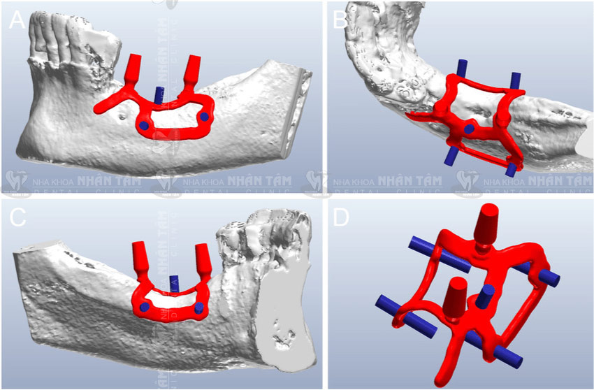 Tỷ lệ thành công của Implant cá nhân hóa đến 97 -98% Tỷ lệ thành công của Implant cá nhân hóa đến 97 -98%