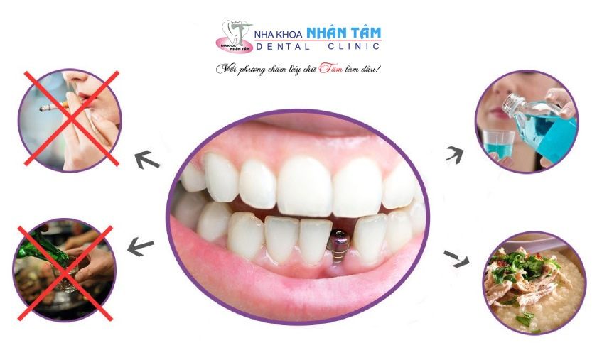 Nên tuân thủ các chỉ định của bác sĩ trước và sau cấy ghép Implant Nên tuân thủ các chỉ định của bác sĩ trước và sau cấy ghép Implant