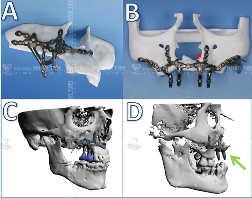 Cấy ghép Implant cá nhân hóa (Implant dưới màng xương) Cấy ghép Implant cá nhân hóa (Implant dưới màng xương)
